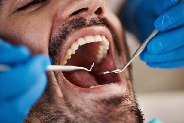 Best Emergency Dental Care for Broken or Chipped Teeth in Lexington Hills, CA